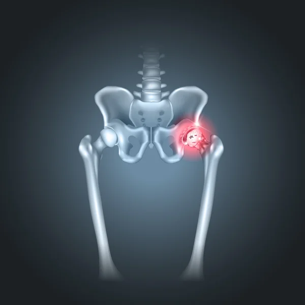 Focus on the Hip Part 2 – Osteoarthritis